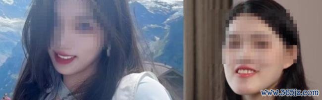 女子正颌被做成鞋拔子脸 官方介入 手术失误引发争议