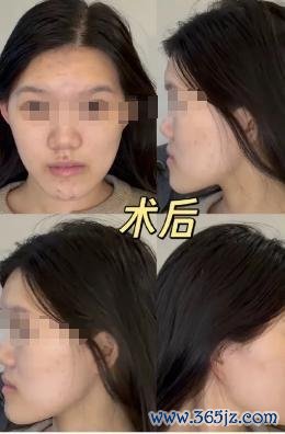 女子正颌被做成鞋拔子脸 官方介入